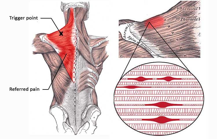 Dry needling / Ultrasound dry needling